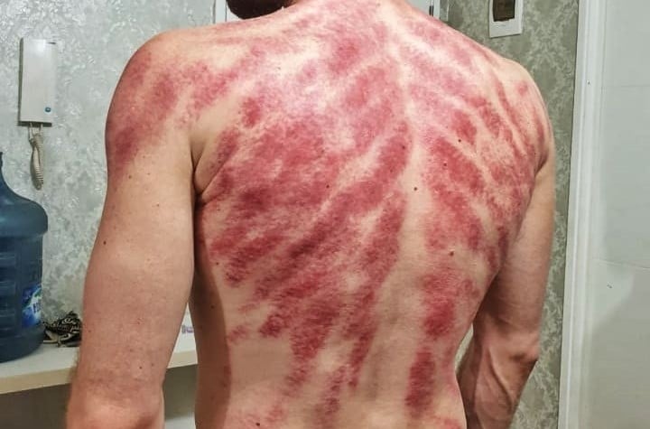 A practitioner using a coin to perform kerokan skin scraping on a person’s back with oil applied